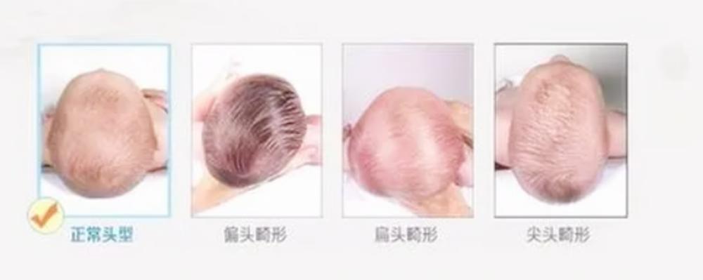 孩子头型偏了是不是扎辫子都不正,5个月宝宝头型不正还可以纠正吗