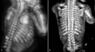 胎儿脊柱超声正常表现是怎样的,胎儿脊柱的超声诊断