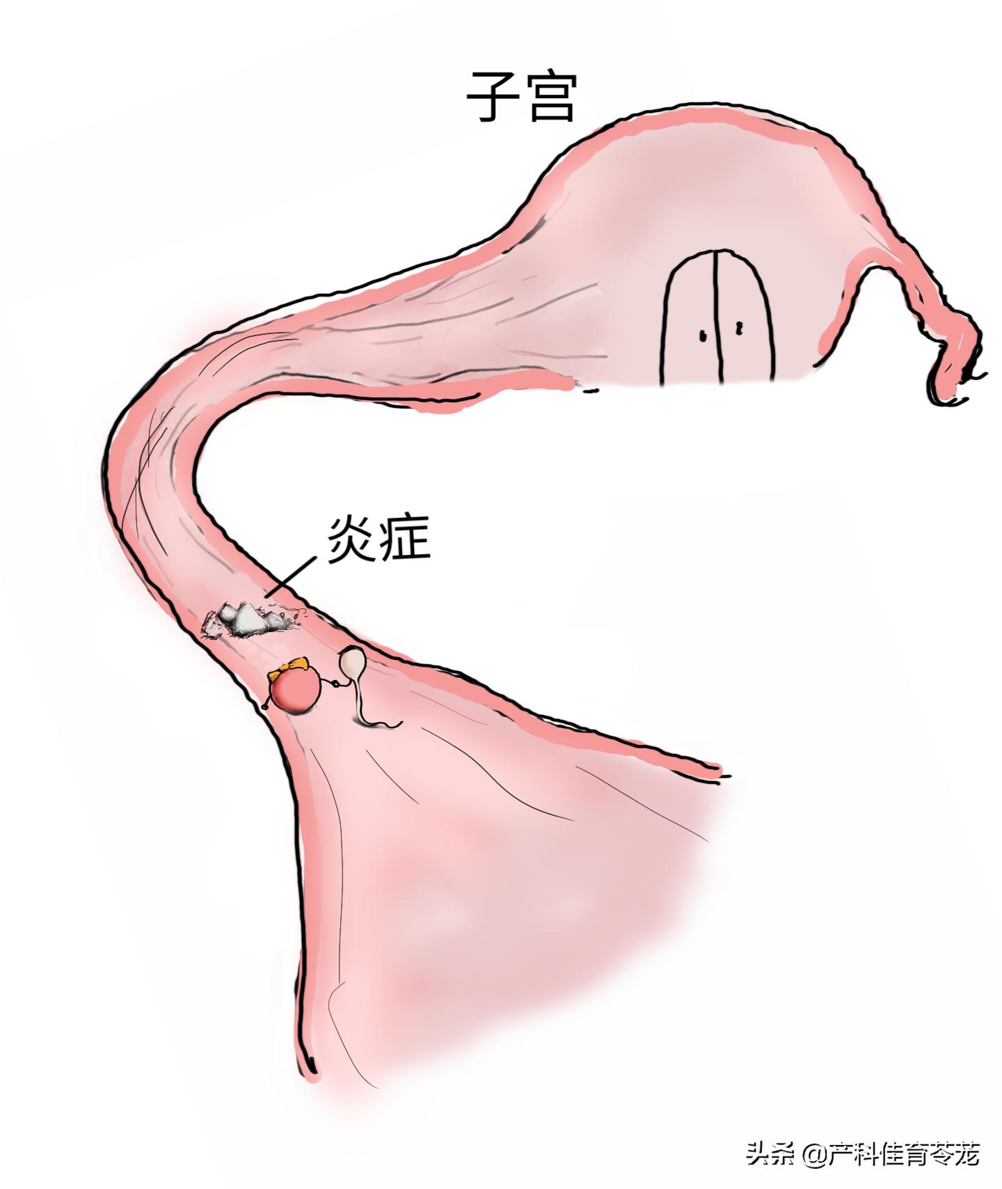 好怕输卵管堵塞怎么办,排卵后输卵管隐隐痛怕宫外孕