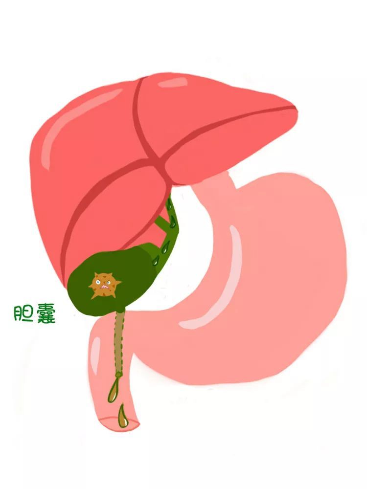 有胆结石要不要割,有胆结石要把胆囊全部切除吗