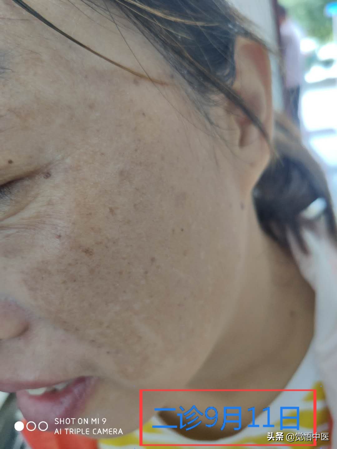 褐青色斑中医疗法,褐斑治疗药物