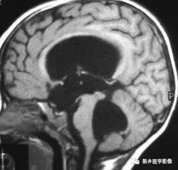 什么引起成人脑室扩大,哪些病可以导致左侧脑室增宽
