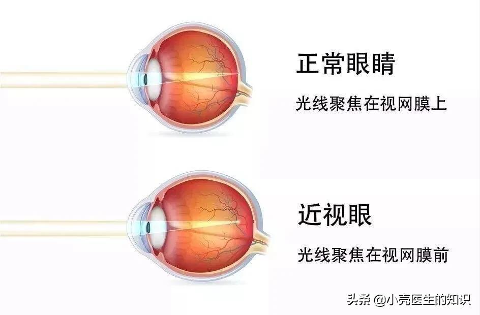 近视的人去游泳该怎么办,近视去游泳戴什么眼镜好