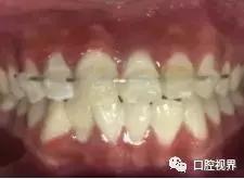 门牙撞了怎么办,门牙意外损坏怎么办