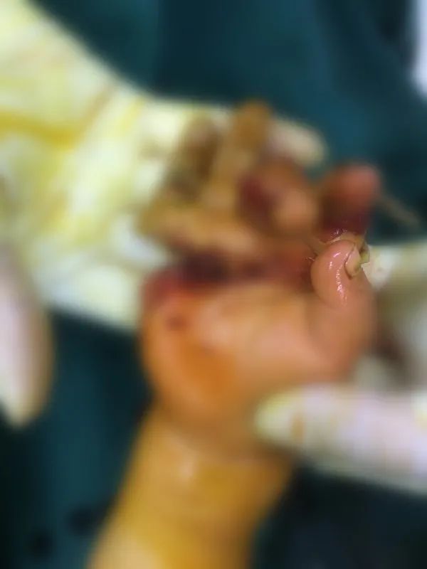 男子不慎断指医生妙手再造手指,男孩手被割伤险断指医生极力救治