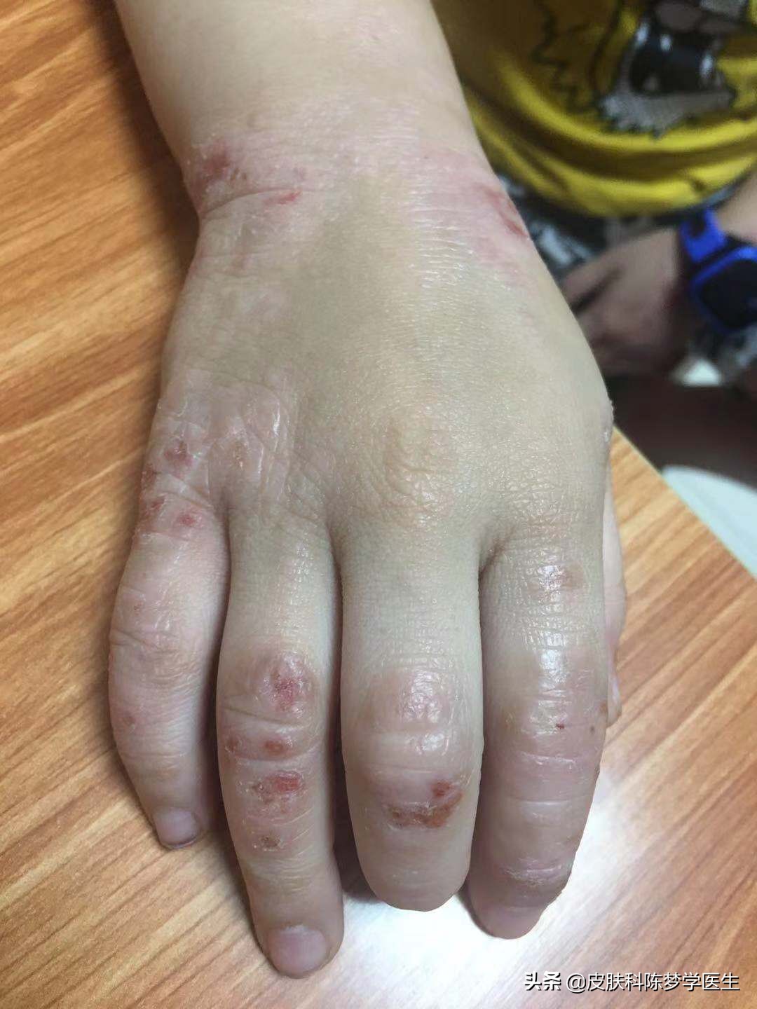 皲裂性湿疹怎么治,湿疹能不能治得好