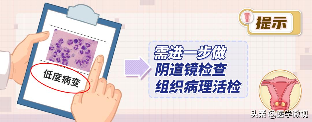 tct和hpv检查哪个确诊宫颈癌,宫颈癌tct检查是什么结果