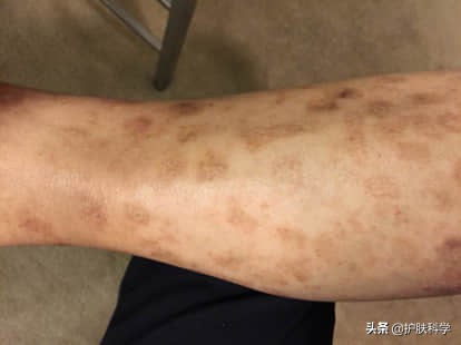 脸上长斑怎么办快速解决方法,脸上长黑斑怎样才能最快消除斑