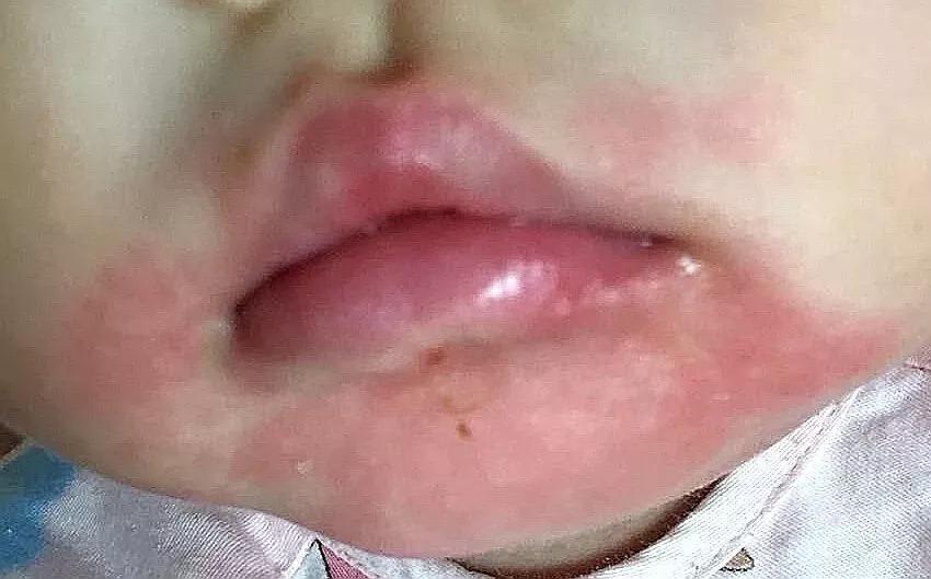 湿疹似乎是一种治不好的病,湿疹和痒疹是同一种病吗