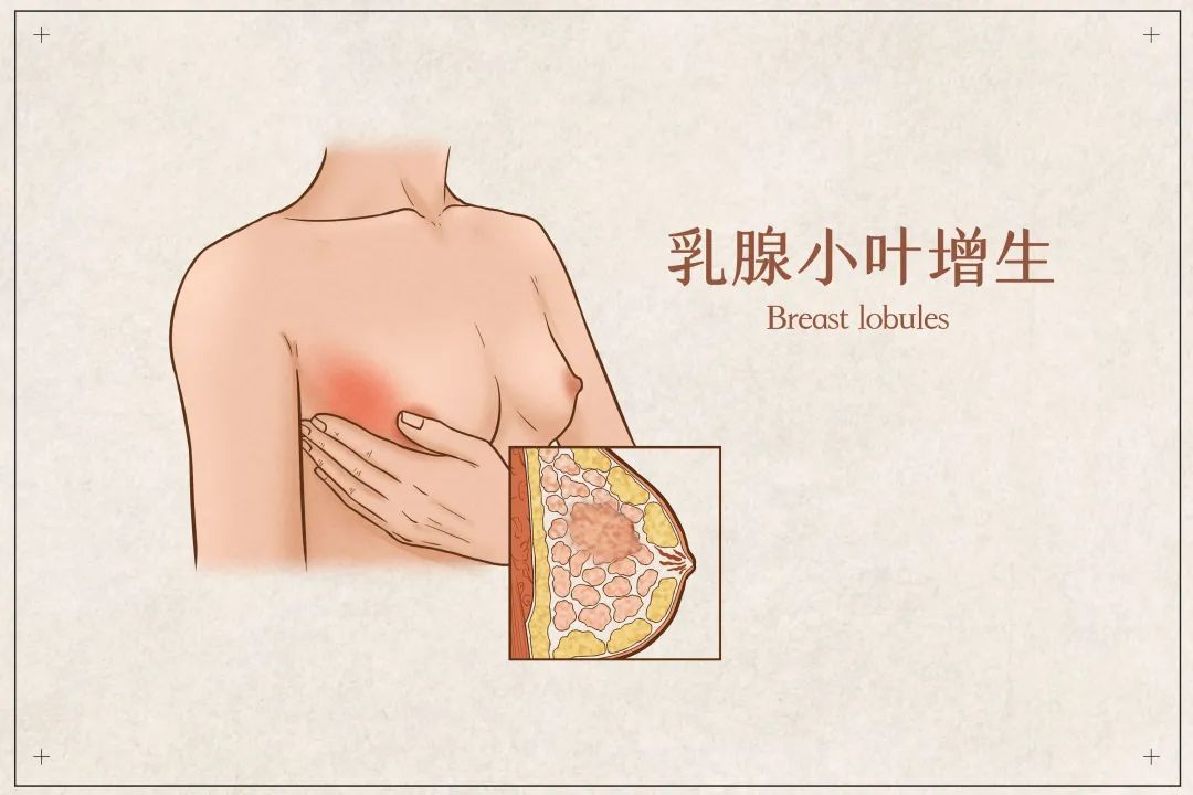重度乳腺增生到乳腺癌多长时间,乳腺增生离癌有多远