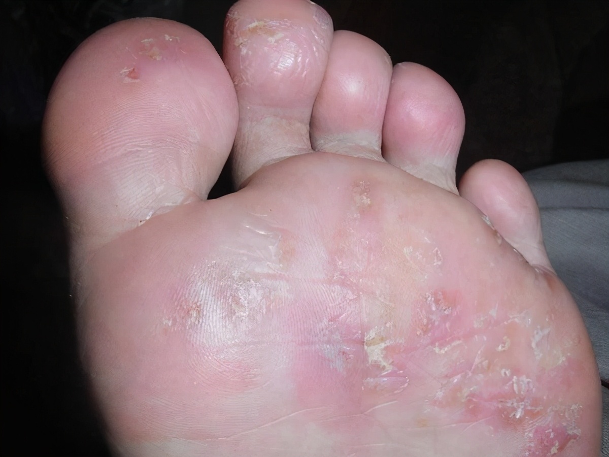 脚气反复奇痒无比,脚气引起全身痒怎么治