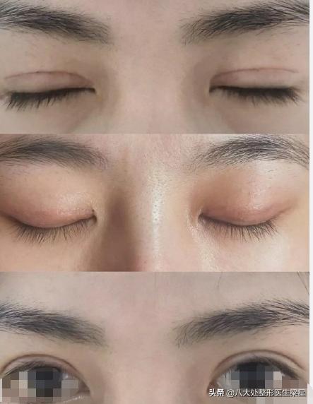 双眼皮手术开眼角恢复过程,双眼皮全切开眼角恢复期图