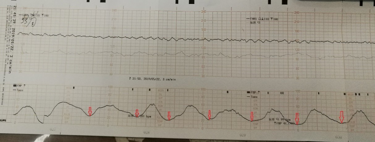 二胎妈妈每天都很难受,为什么感觉二胎假性宫缩很频繁