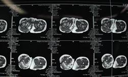 淋巴血管畸形治疗费用,淋巴静脉畸形治疗