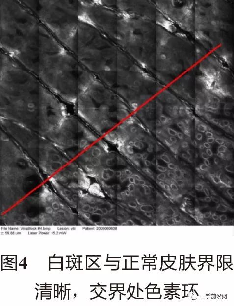 皮肤共聚焦显微镜能查什么,皮肤镜和共聚焦显微镜