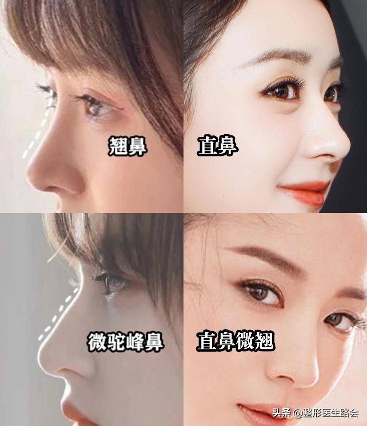 直鼻微翘怎么整,直鼻微翘怎么做出来自然又好看