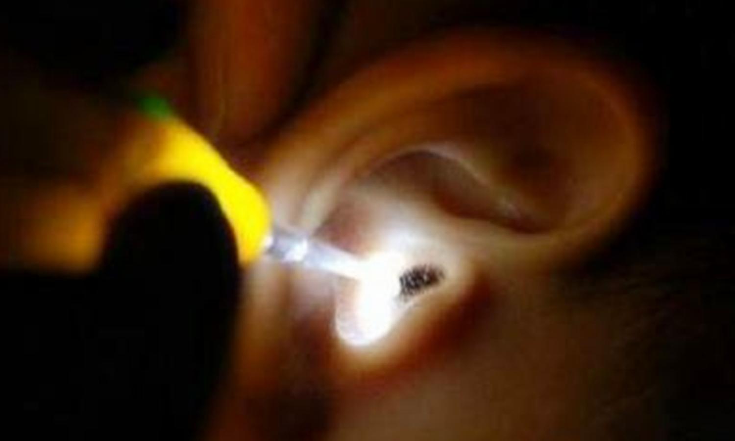 6岁女童耳朵疼取出虫子,小孩耳朵里钻进虫子