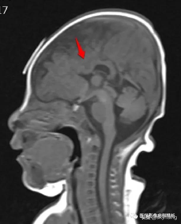 半叶全前脑畸形,无叶型前脑无裂畸形超声表现