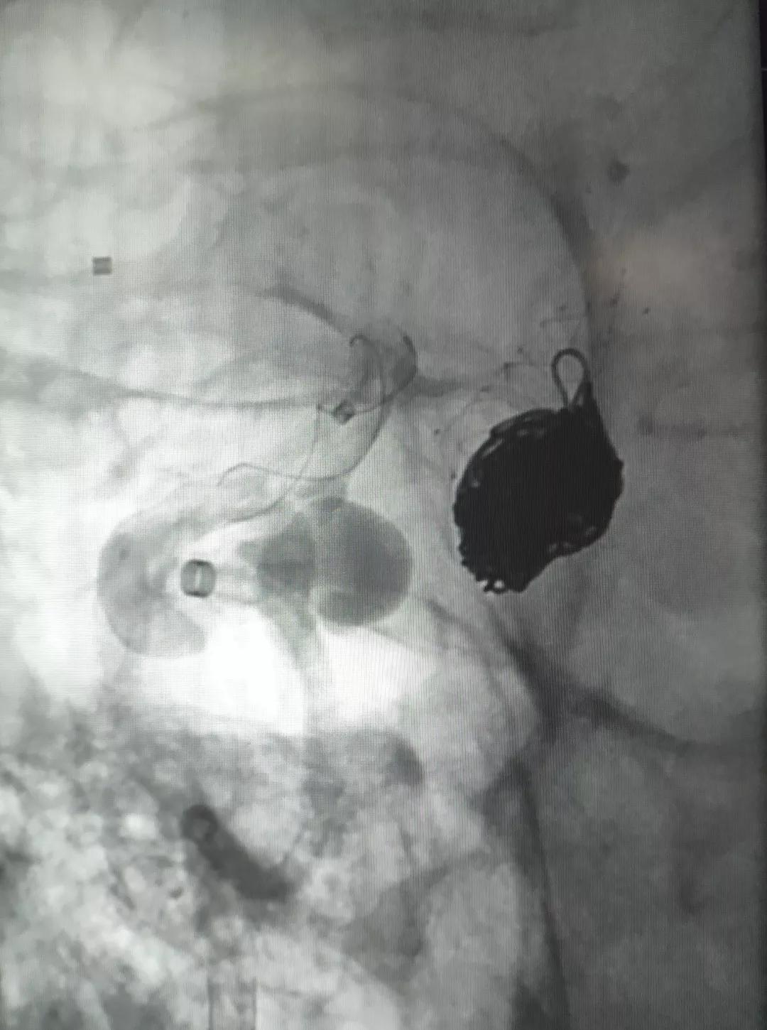 山东大学齐鲁医院王东海教授团队成功治疗多发性动脉瘤