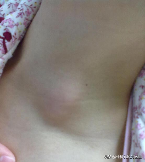 脖子上长疙瘩是什么肿瘤,脖子上有结核淋巴结是否有传染性