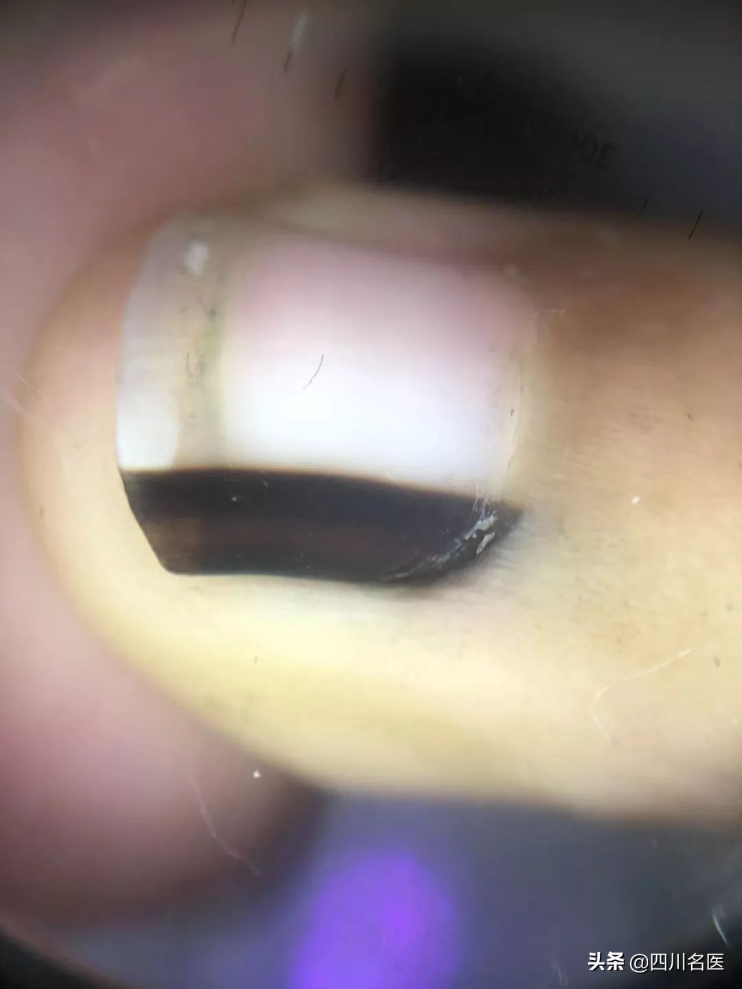 指甲上有黑竖线皮肤科,指甲有黑色斑块挂什么科室