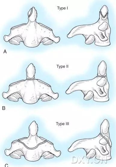 几种严重骨折医学名称,常见的骨折有哪些名称