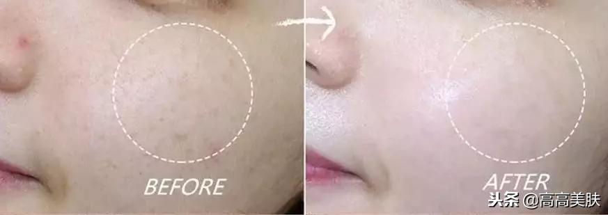 韩国东星制药美白祛斑霜,东星琅丝曲酸小黑瓶祛斑霜