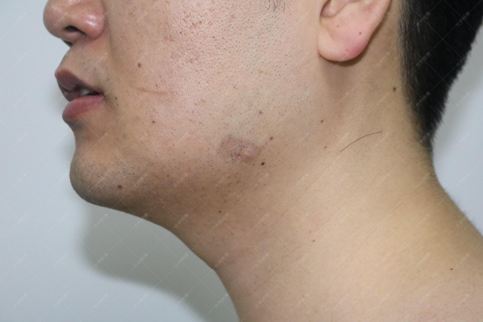 疤康疤痕疙瘩治疗效果怎么样,疤康治疗效果是真实的吗