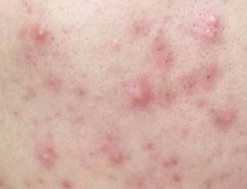 真正有效的祛痘产品,别乱用祛痘产品对症下药才能治痘