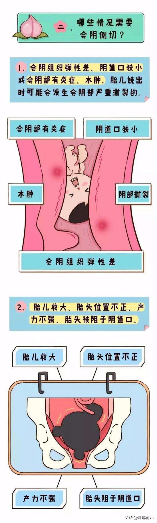 怎么才能防止侧切,怎么才不会被侧切呢