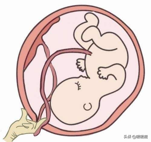 脐带绕颈几周会畸形,脐带扭转和脐带绕颈的区别