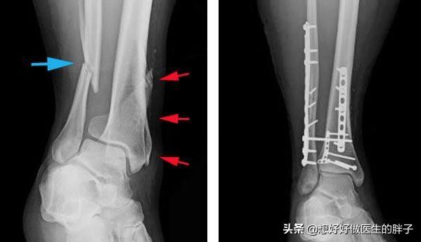 涉及踝关节的骨折，无论是否经历手术，出现粘连如何康复恢复角度