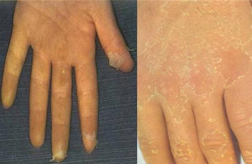 猩红热出完疹子还是发烧怎么回事,发热咽痛出荨麻疹