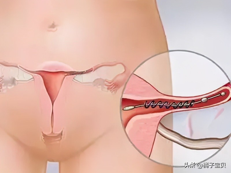 输卵管堵塞了该如何检查？