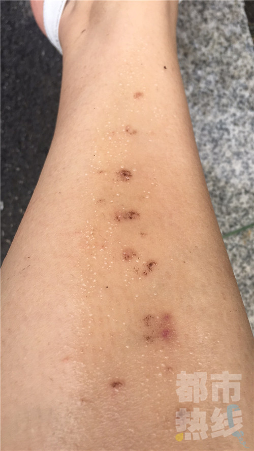 面部激光脱毛后毛发变多,女生激光脱唇毛后色素沉着