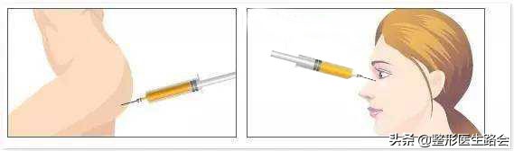 注射泪沟淤青一般需要几天好,胶原蛋白注射泪沟淤青多久能好