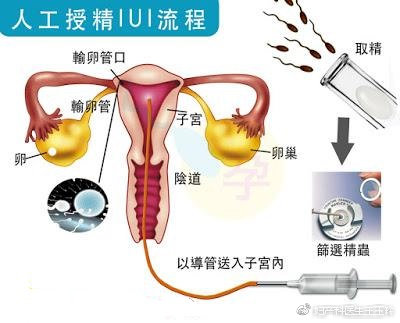 助孕方法与辅助生殖技术细盘点,助孕法
