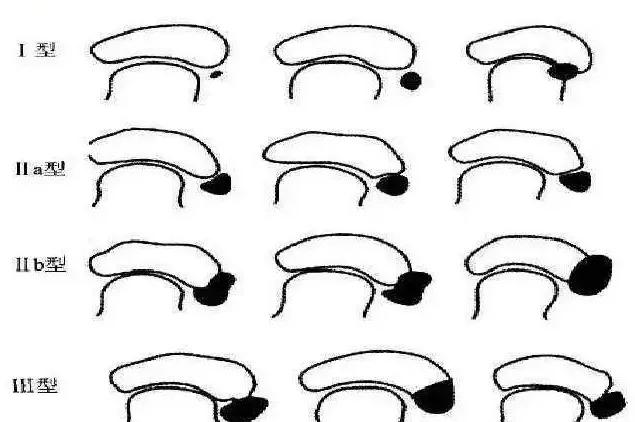 脚上多长了块骨头,腿关节多长了一块骨头