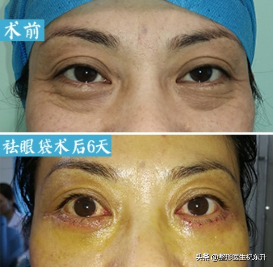 医生不会说的|做眶隔脂肪释放祛眼袋手术缺点太多？