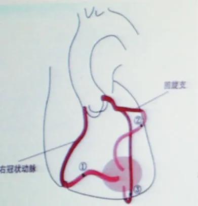 突发心梗心脏骤停怎么办,心梗突然心脏骤停怎么办