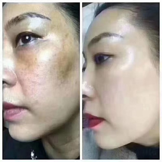 御容芳中药面膜副作用,中药面膜长期使用有什么危害吗