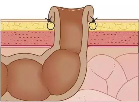 灌肠容易肠道破裂吗,灌肠可以把肠管捅破吗