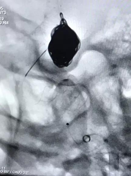 山东大学齐鲁医院王东海教授团队成功治疗多发性动脉瘤