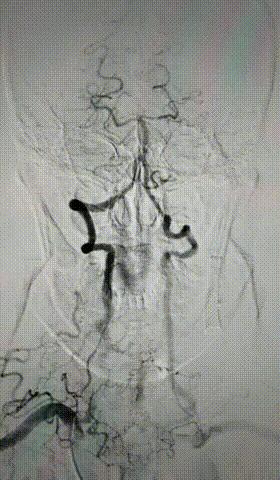 脑卒中发生时自己怎么自救,脑卒中急救黄金1小时