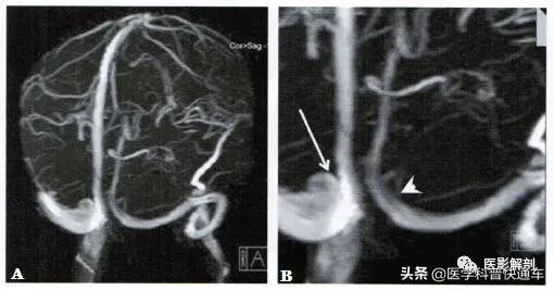 颅内静脉窦变异,颅内静脉窦变异I型什么意思