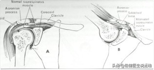 肩峰撞击综合征怎么办,游泳肩的治疗