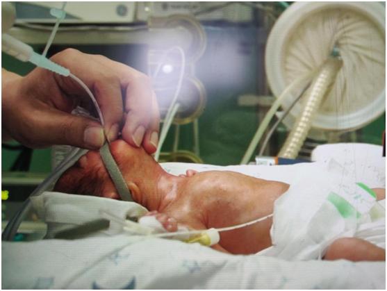 守护生命的奇迹|聊城市二院新生儿科率先成功开展LISA技术