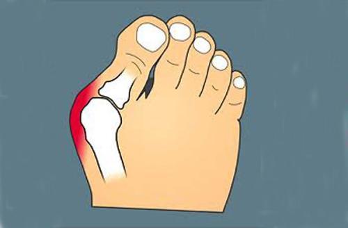 拇趾外翻的克星,拇外翻怎么矫正女孩