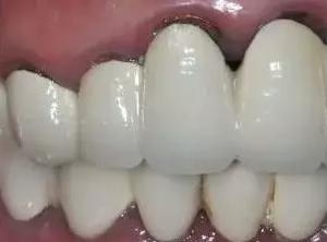 牙龈和牙齿缝黑黑的刷不掉怎么办,牙龈为什么会变黑怎么改善