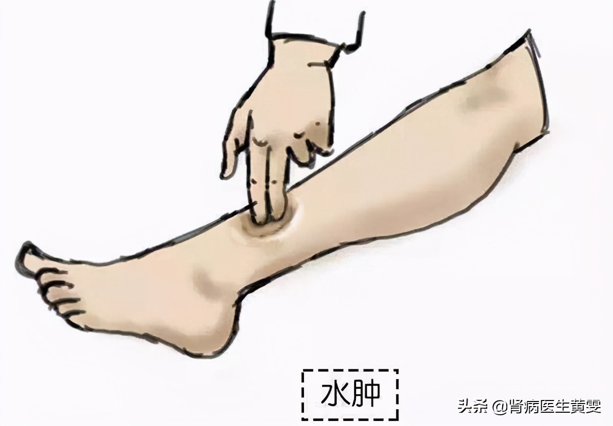 肾病病人如何控制水肿的科普视频,老年肾病水肿怎么快速消肿